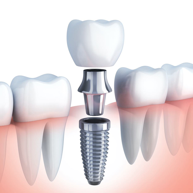 PROMO implante dental