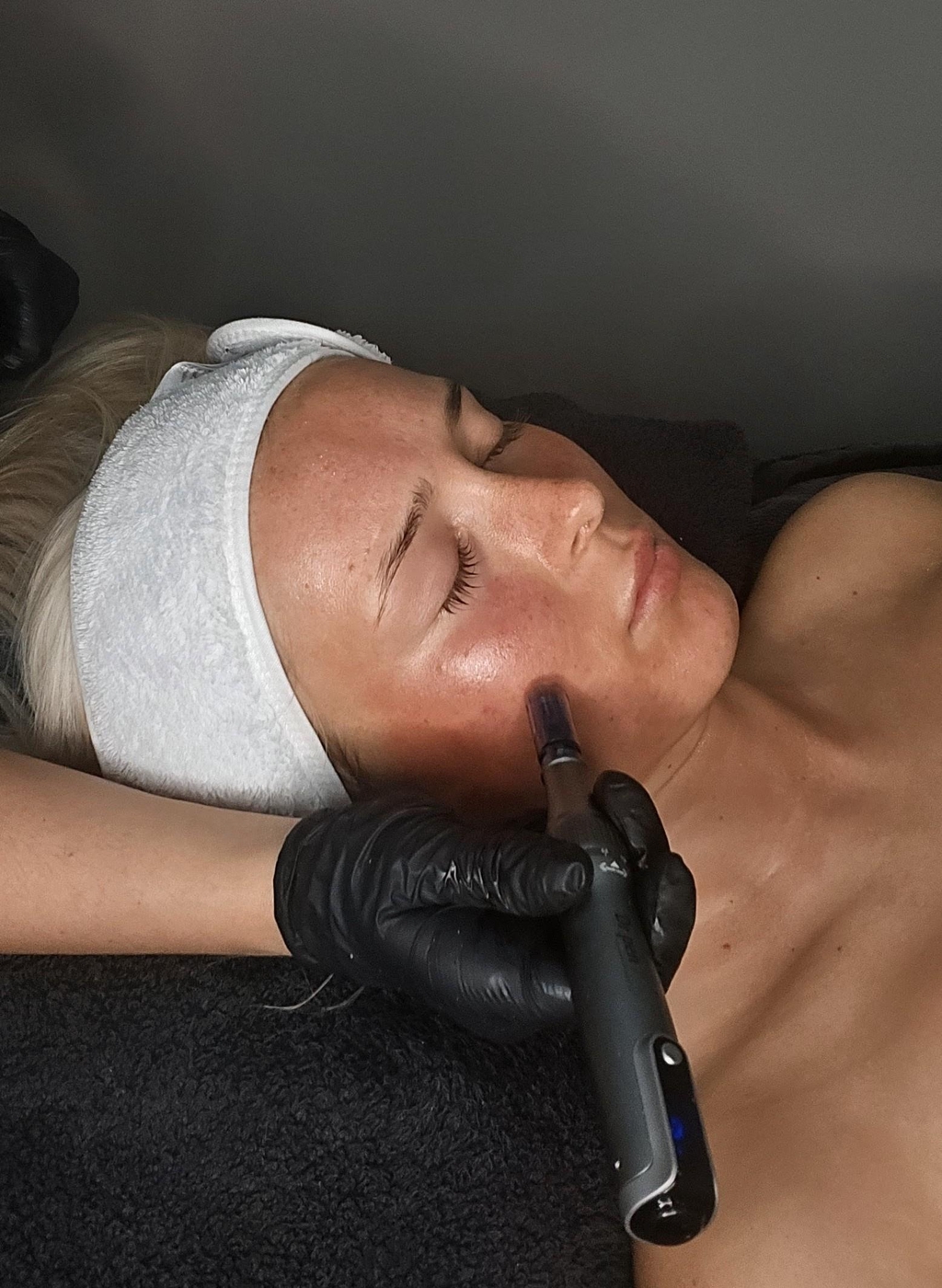 Clinicare Mesotherapy Microneedling & Chemical Peels