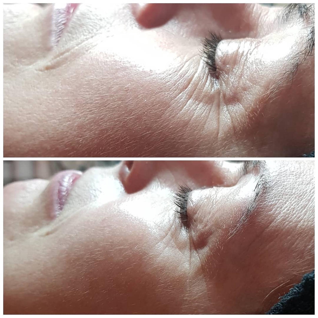 Soins Anti rides 
à Baillargues 
Ou à domicile Montpellier Mauguio Le crès Carnon La Grande motte Nîmes Sommières 
Sète Cap d'Agde 