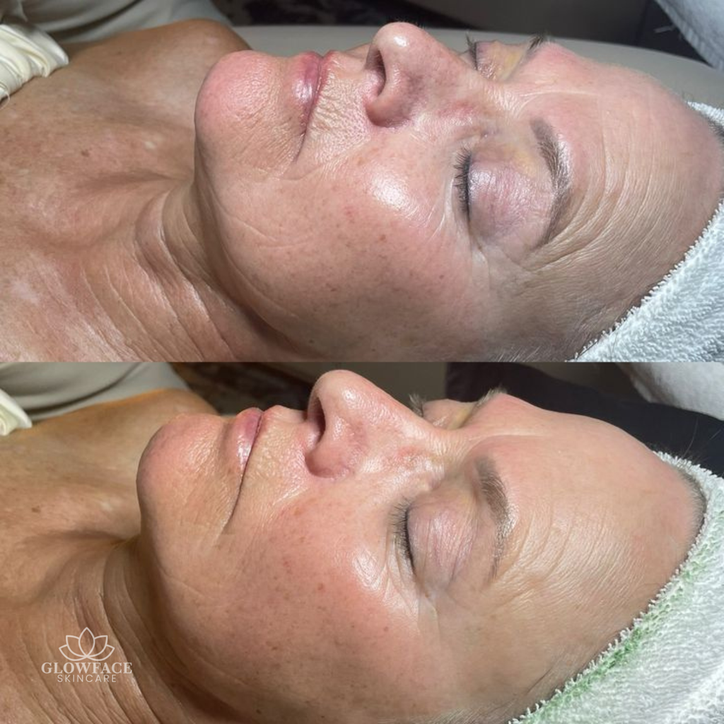 Microneedling Schwalbach am Taunus