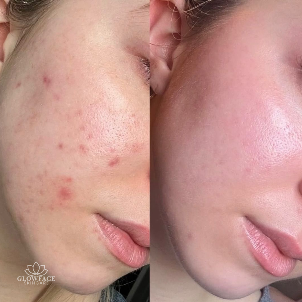 Aquafacial und Microneedling Schwalbach am Taunus
