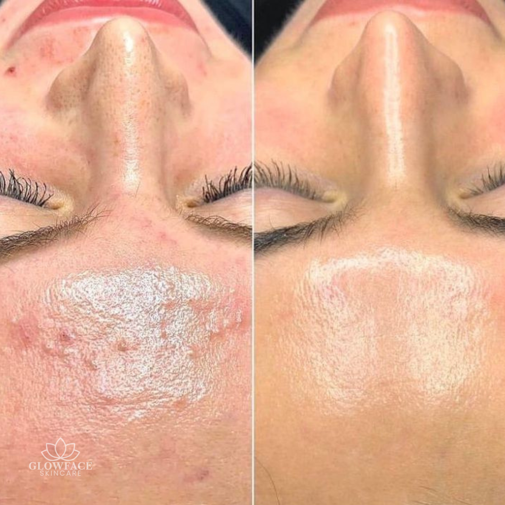 Aquafacial und Microneedling Schwalbach am Taunus