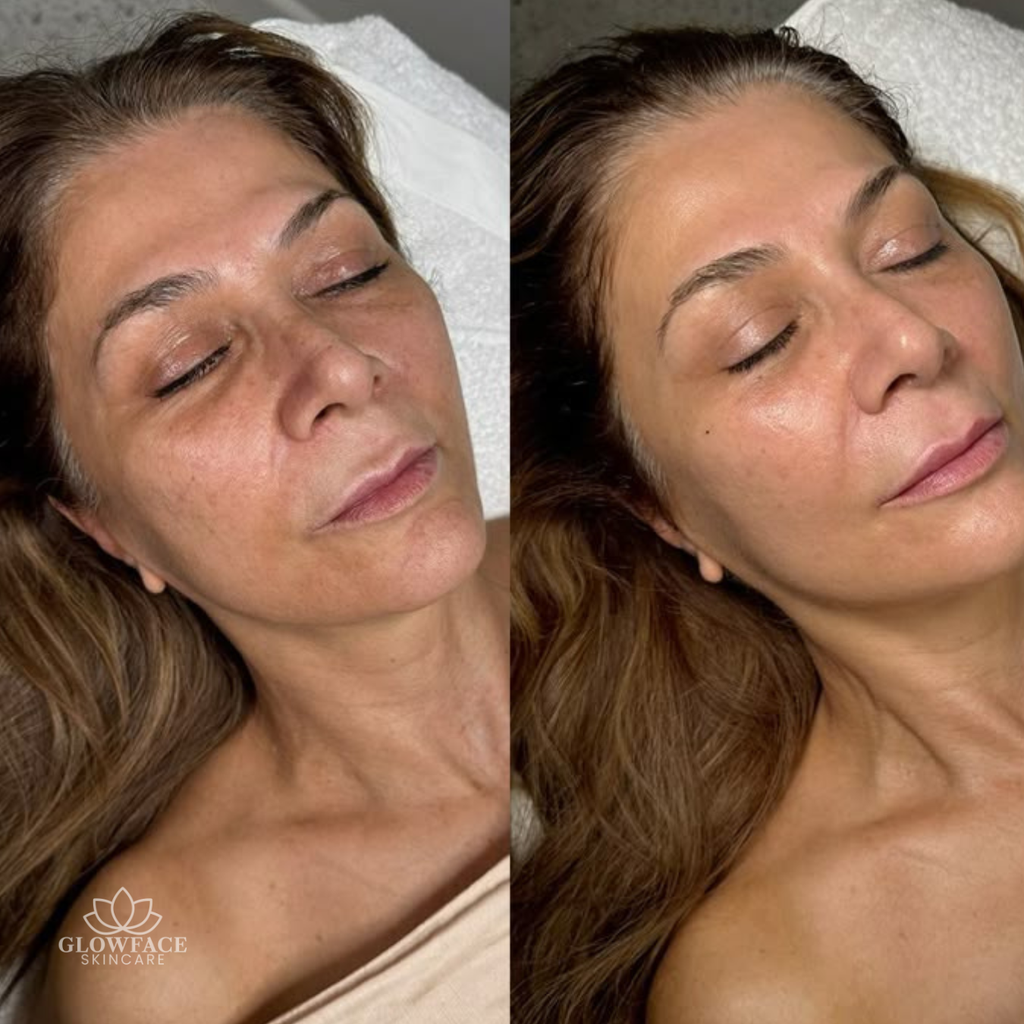 Microneedling Schwalbach am Taunus