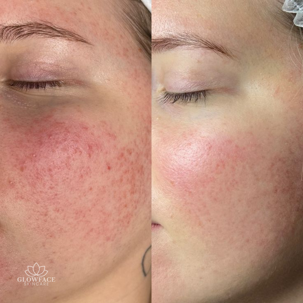Aquafacial und Microneedling Schwalbach am Taunus