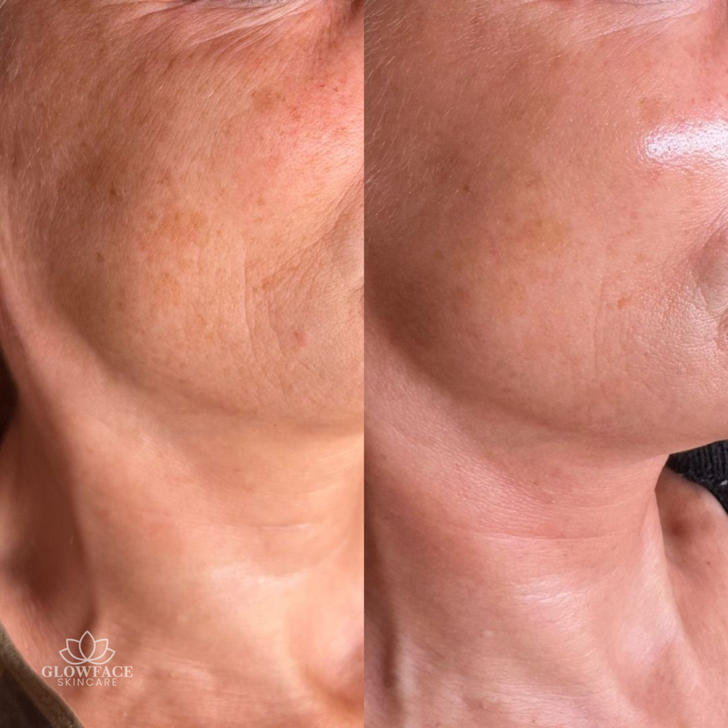 Microneedling Schwalbach am Taunus