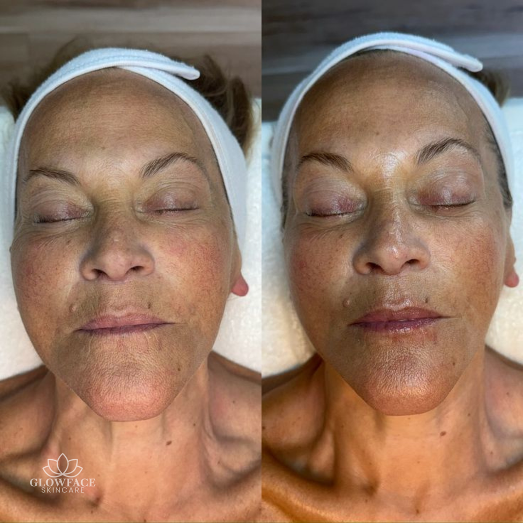 Microneedling Schwalbach am Taunus