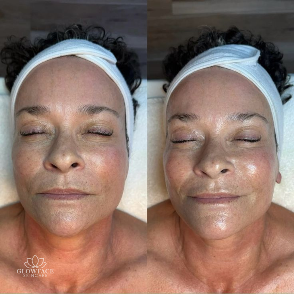 Microneedling Schwalbach am Taunus