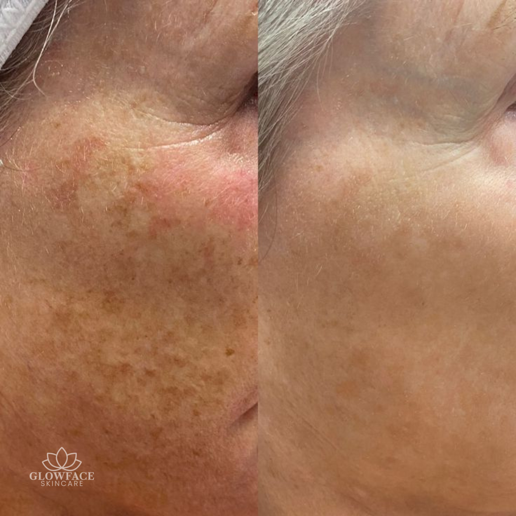 Microneedling Schwalbach am Taunus