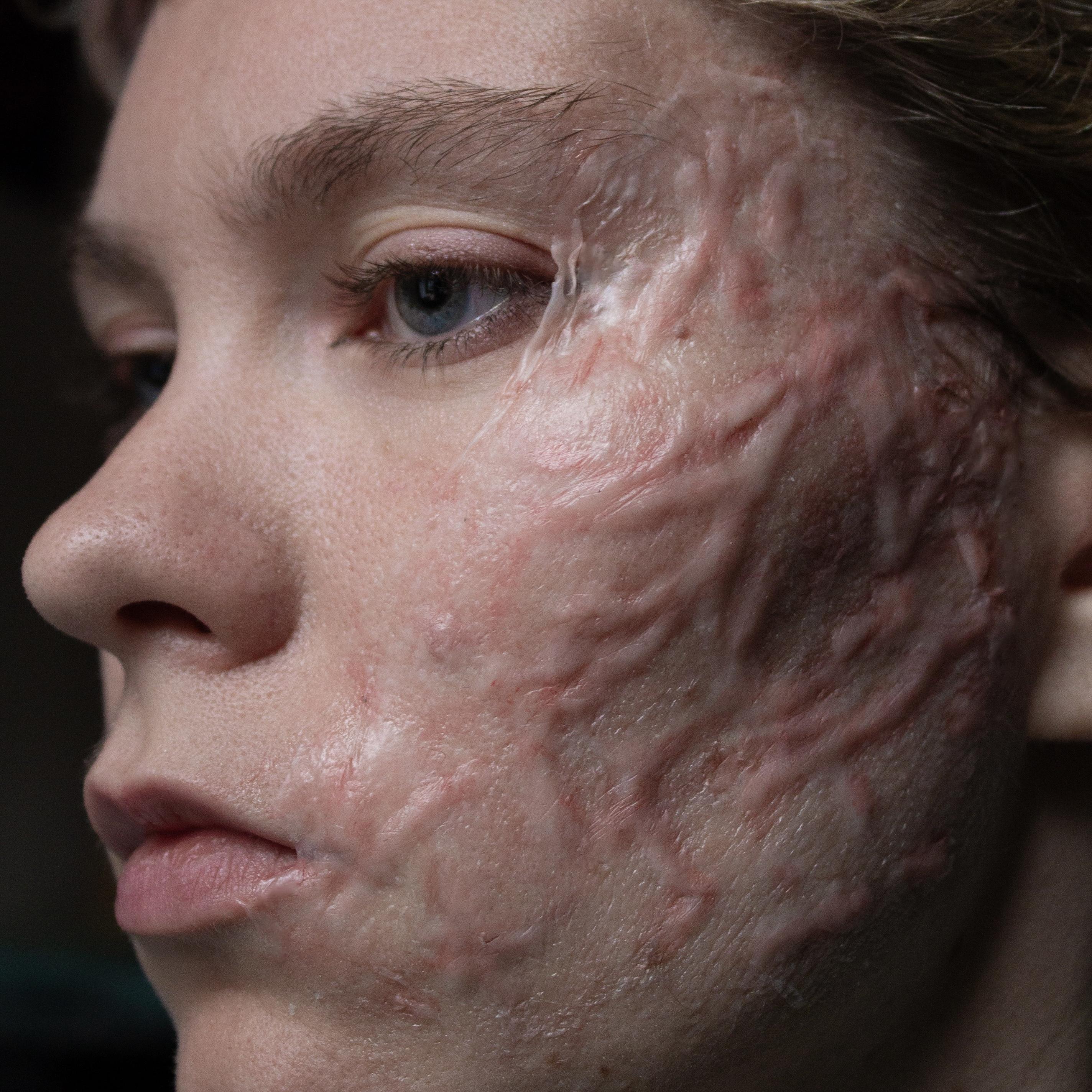 HD Prosthetics