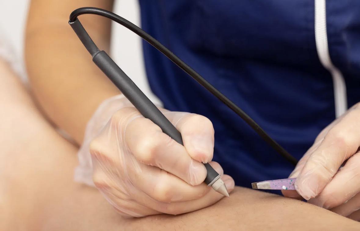 Epilation électrolyse