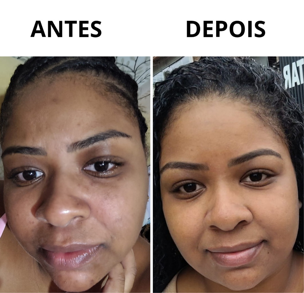 Imagem de antes e depois de uma cliente mostrando o ótimo resultado do Kit Move em sua pele.