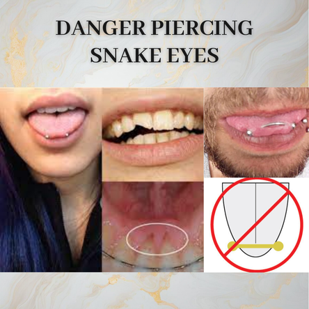 
DANGER SNAKE-EYES
La langue étant constituée de plusieurs muscles lui permettant de bouger dans toutes les directions, ce piercing a pour effet de les embrocher ensemble, limitant ainsi ses mouvements. Cela peut créer des problèmes d'élocutions pouvant continuer de façon définitive même une fois le piercing retiré.
Pourquoi ce piercing est fortement déconseillé
et refusé par tous les (bons) perceurs ?
La suite dans la prochaine Story
L'emplacement de ce piercing ne permet pas de connaître le placement des veines afin de les éviter (contrairement au piercing à la langue classique). Vous prenez donc le risque de crever une veine > hémorragie > urgences

Ce piercing provoque des chocs sur les dents (sans compter les morsures accidentelles sur les billes) pouvant les endommager voir les casser définitivement.

De plus, le risque de rejet est élevé puisqu'il s'agit d'un piercing de surface réalisé sur un muscle en mouvement. Le rejet peut provoquer une cicatrice profonde et visible sur le devant de votre langue, ainsi qu'une perte de sensation et de mobilité.
DANGER SNAKE-EYES
Un perceur acceptant ce piercing = gros redflag ! 


Tu connais quelqu’un qui veut ce piercing ?
Je compte sur toi pour l’en dissuader !